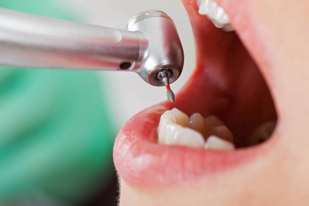 Best Emergency Tooth Extraction in New London, TX